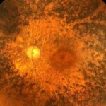 retinosis-pigmentaria